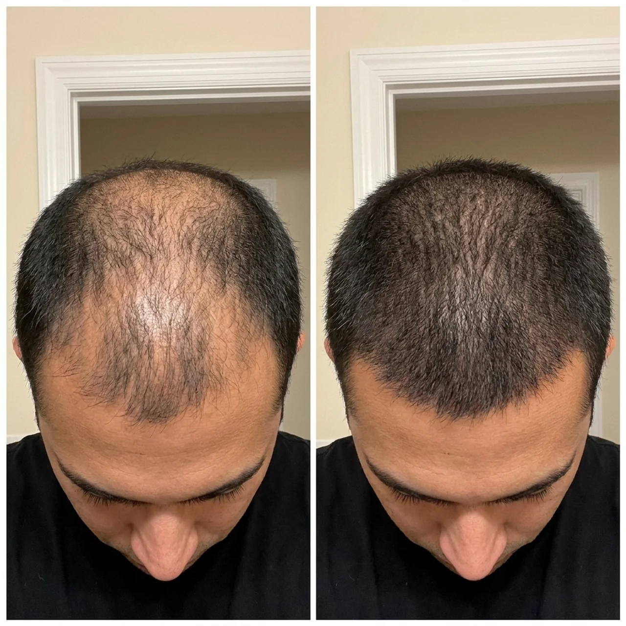 Before and after photo illustration of the front scalp