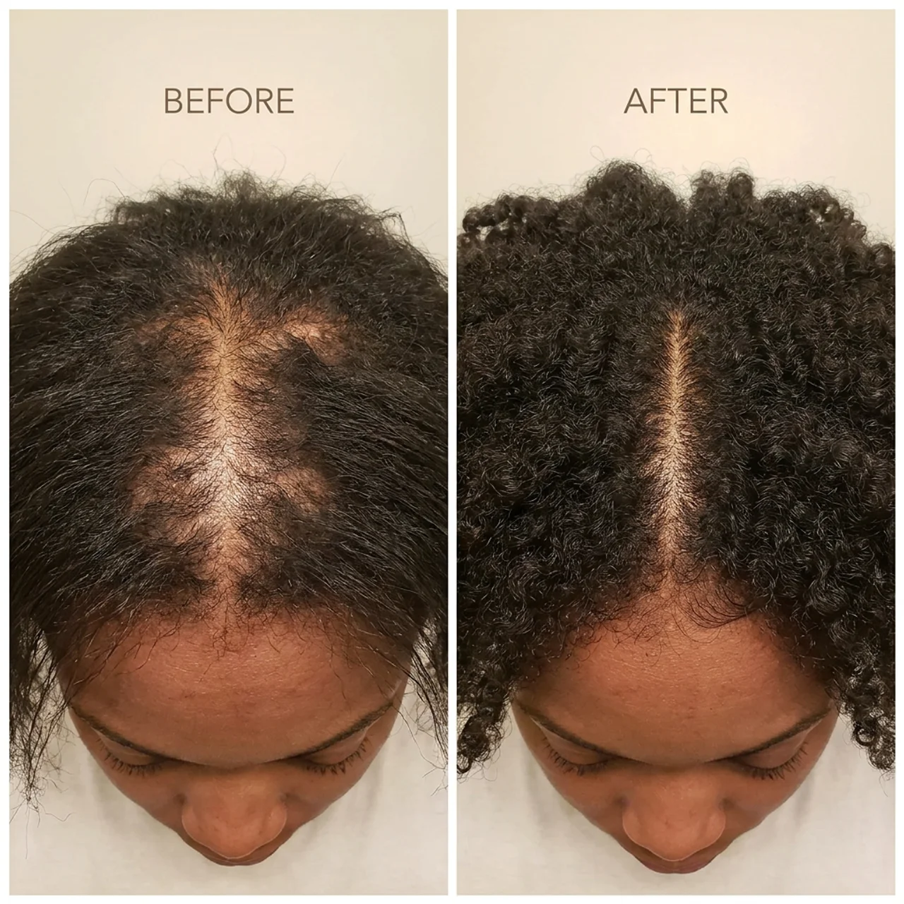 Before and after comparison of the scalp along the part line